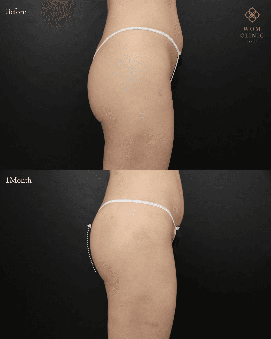 Brazilian Butt Lift (Condensed Fat Buttock Augmentation): before and one month after surgery — side view