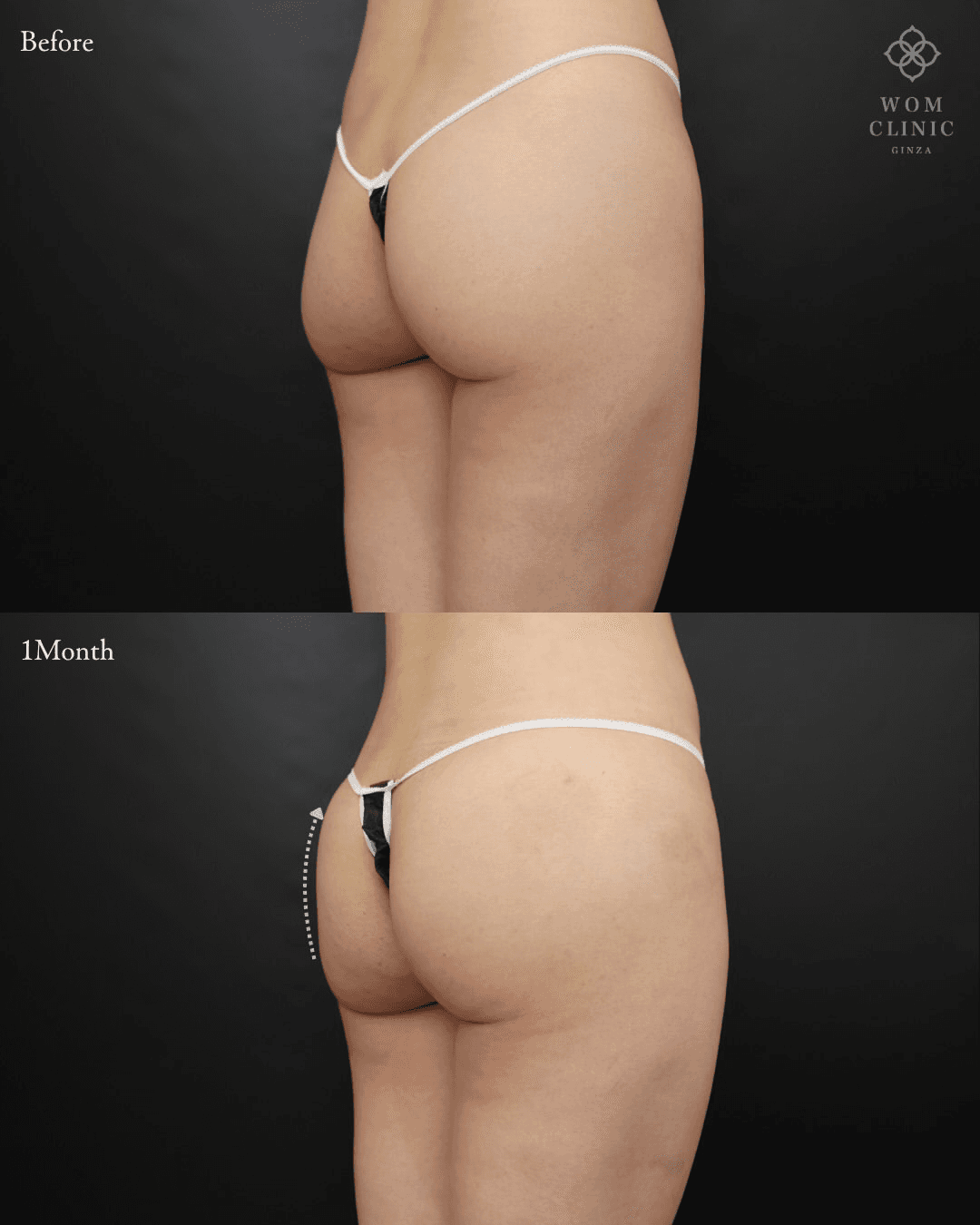 Brazilian Butt Lift (Condensed Fat Buttock Augmentation): before and one month after surgery — oblique view