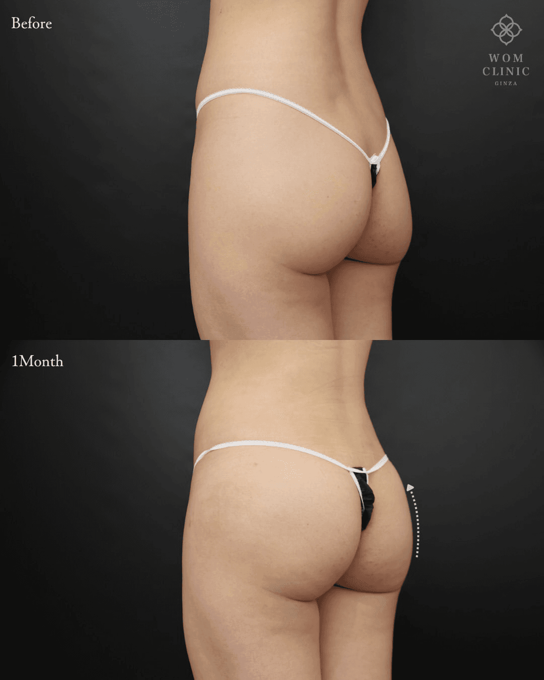 Brazilian Butt Lift (Condensed Fat Buttock Augmentation): before and one month after surgery — oblique view