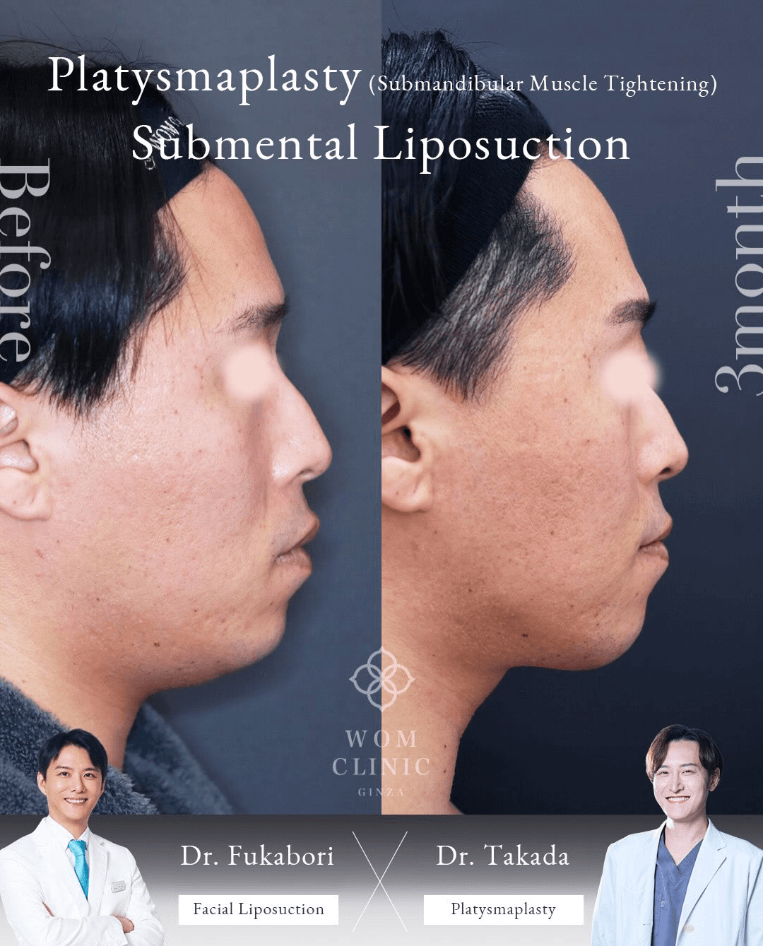 Comparison before surgery and three months after platysmaplasty and submental liposuction