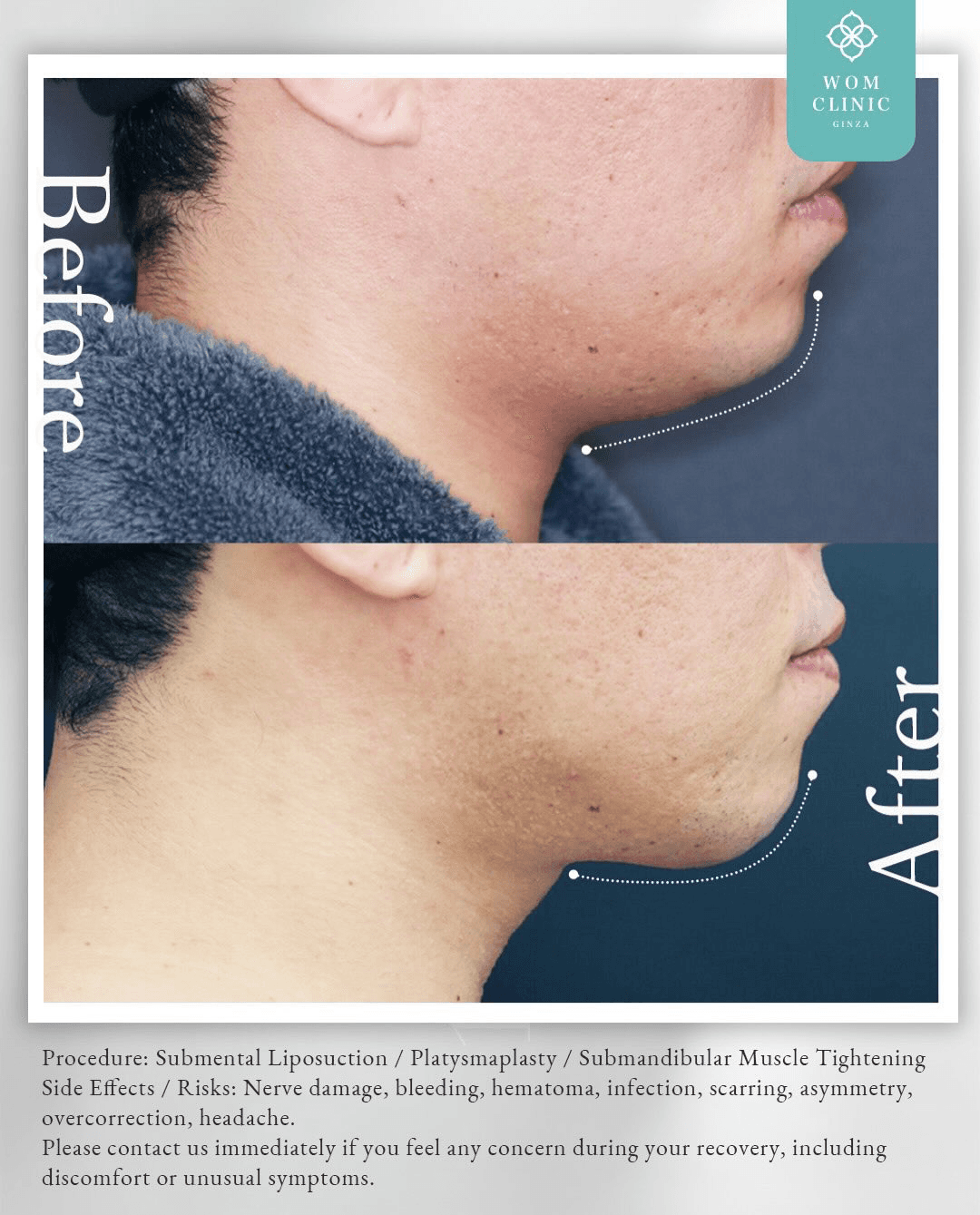 Close-up comparison of the submental area before and after platysmaplasty