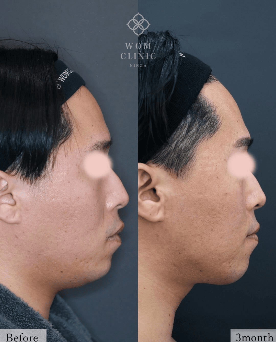 Side-profile comparison before surgery and three months after treatment