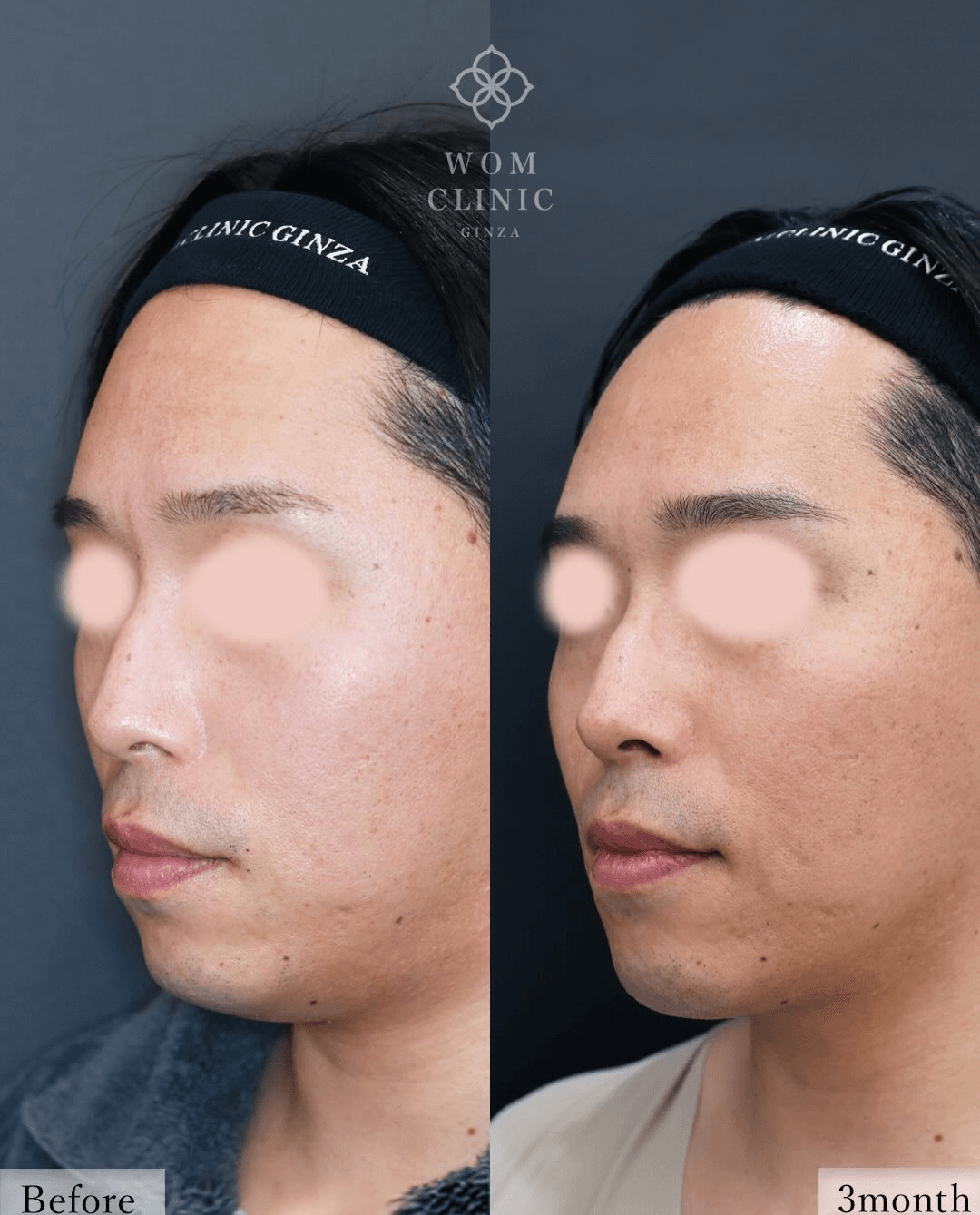 Oblique-view comparison before surgery and three months after treatment