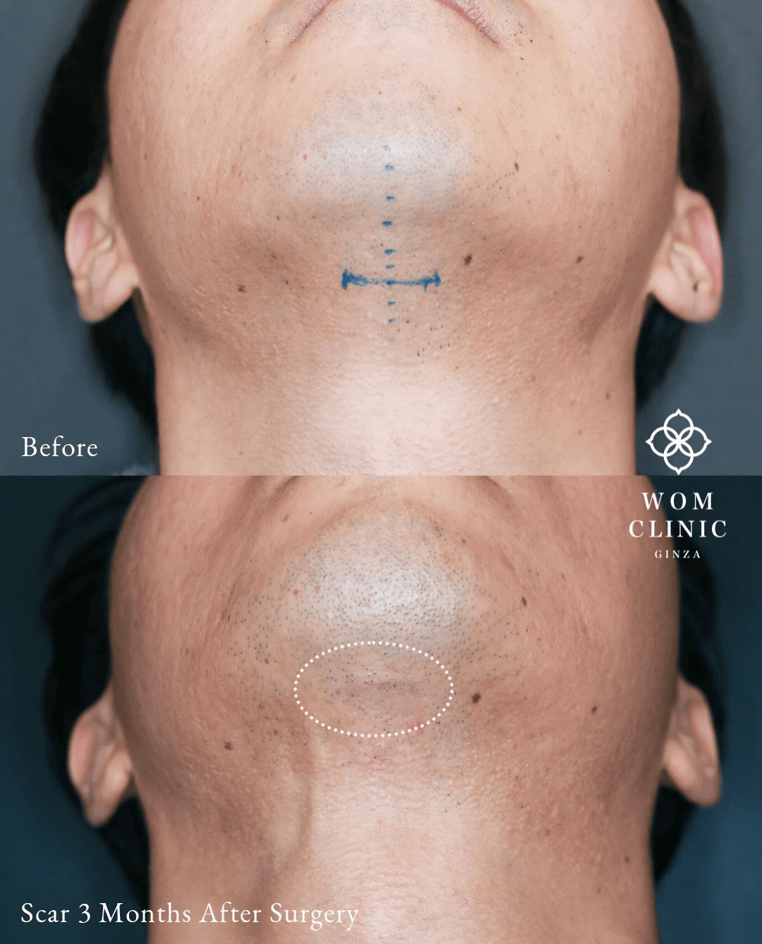 Comparison of the submental incision before surgery and three months after surgery