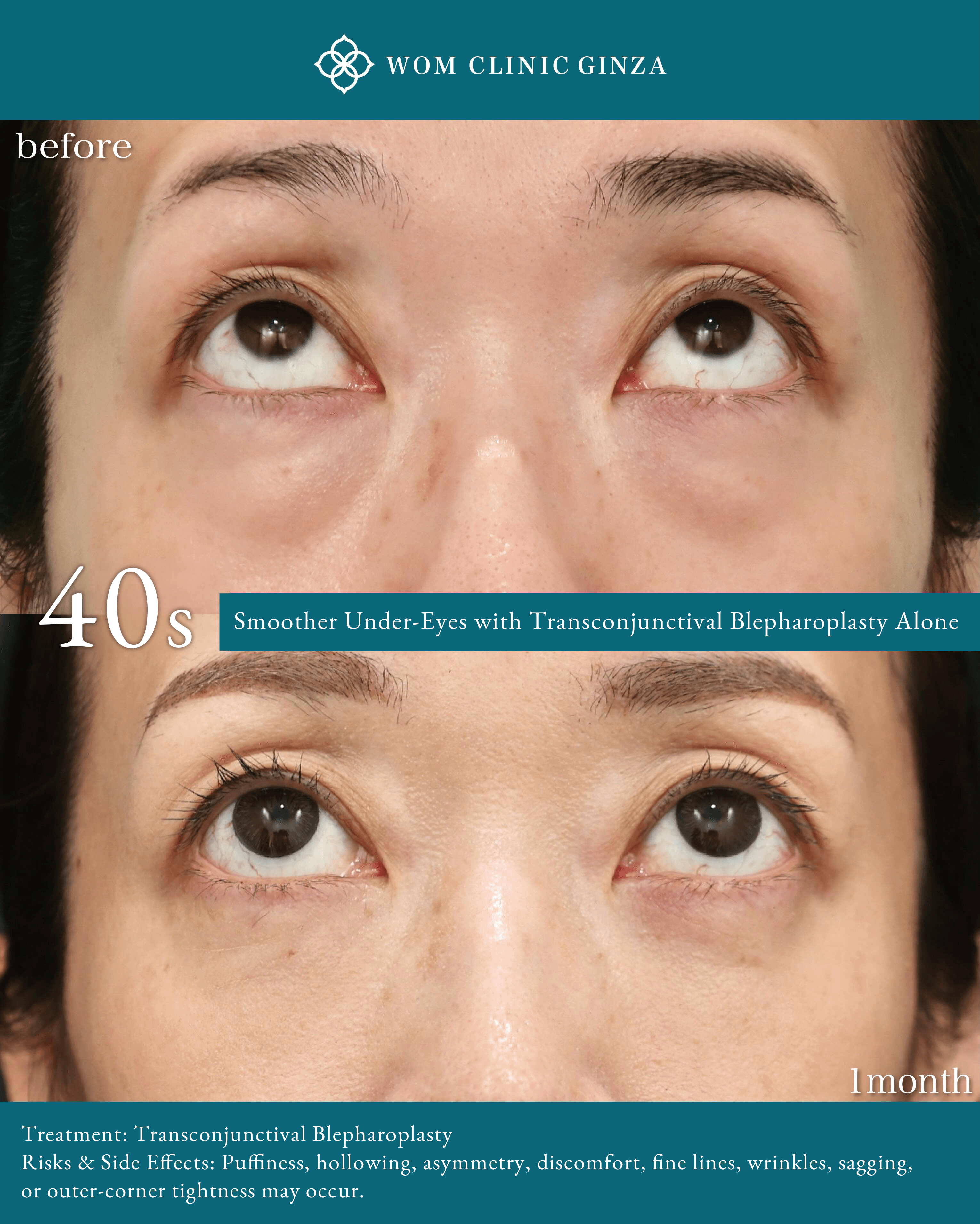 Case photos comparing the patient looking upward before and one month after Transconjunctival Blepharoplasty