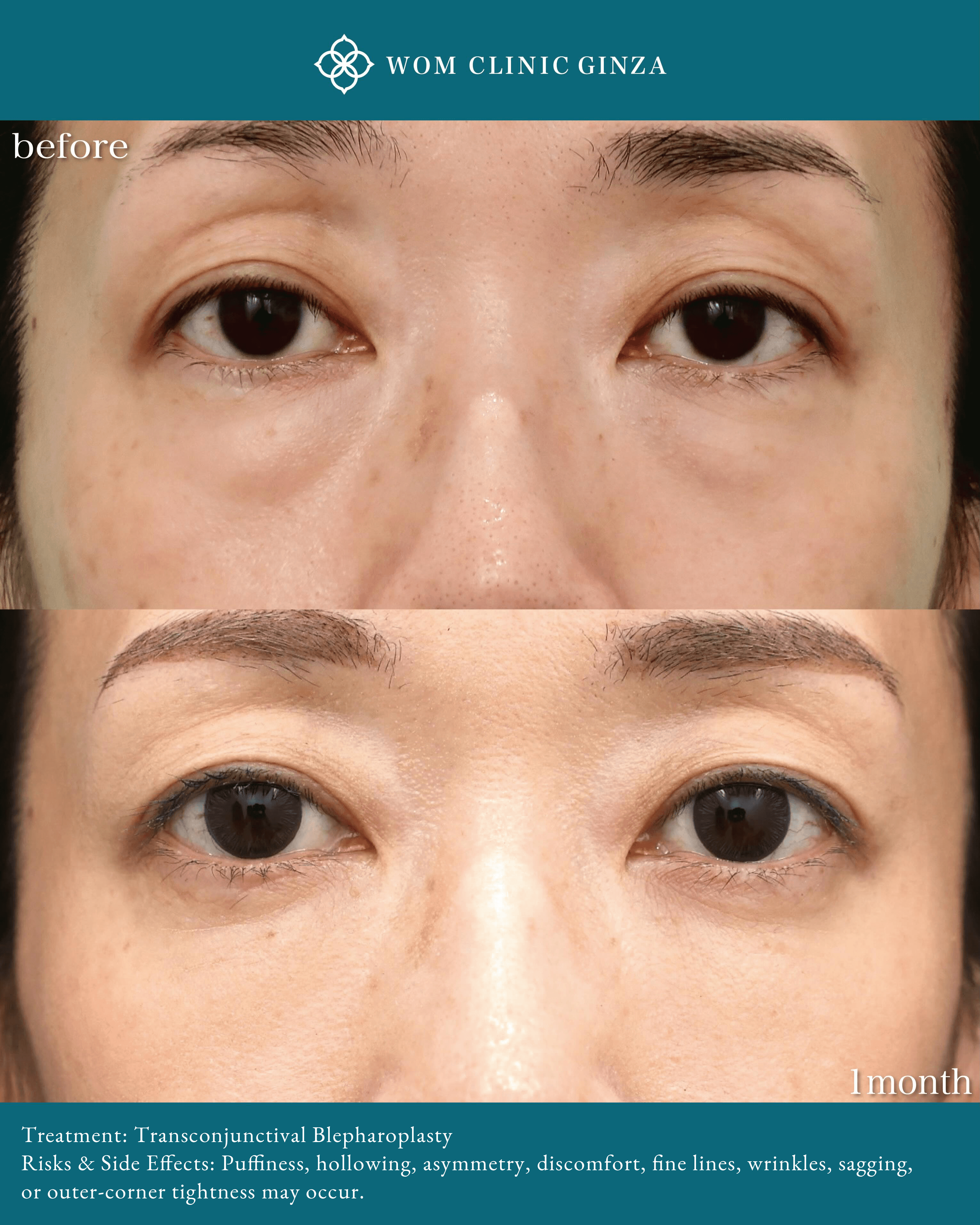 Case photos comparing the patient looking upward before and 1.5 months after Transconjunctival Blepharoplasty