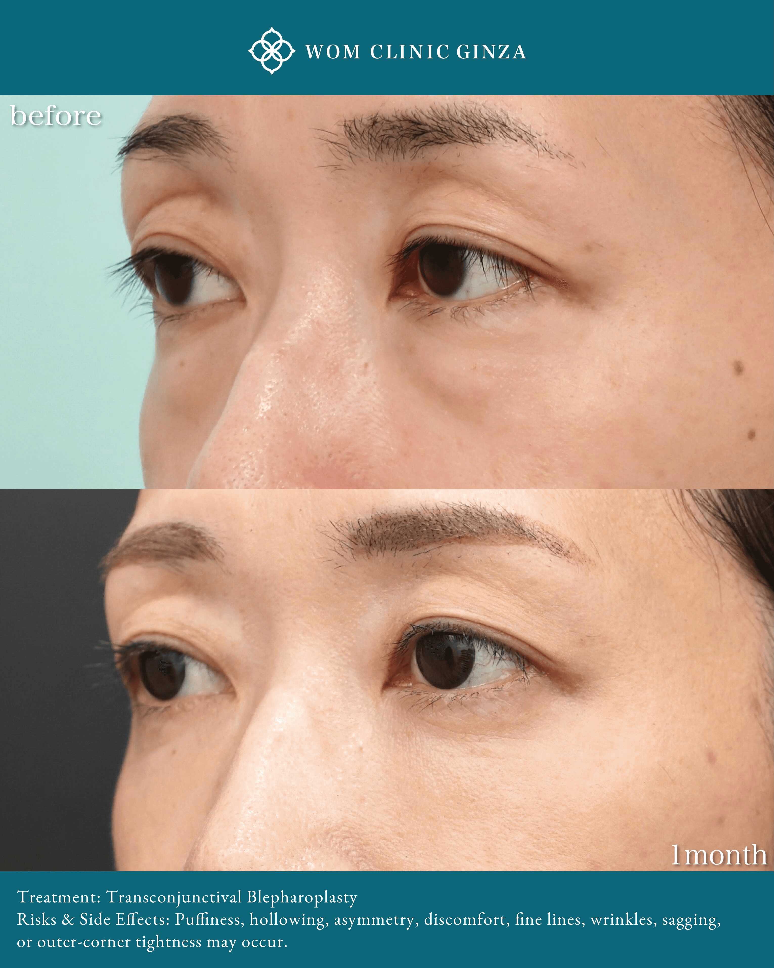 Case photos before and 1.5 months after Transconjunctival Blepharoplasty