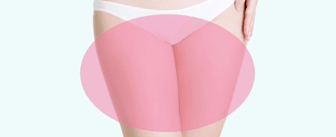 Thigh liposuction areas