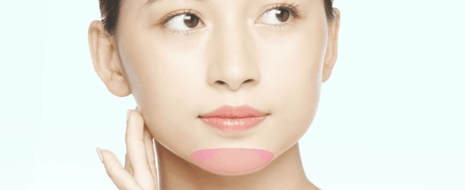 Treatment area for chin implant surgery