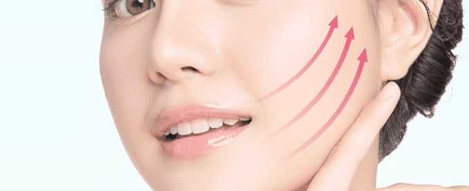Treatment areas for a thread lift