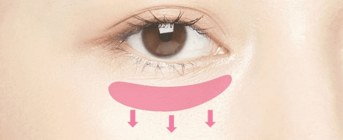 Transconjunctival and Transcutaneous Blepharoplasty treatment area
