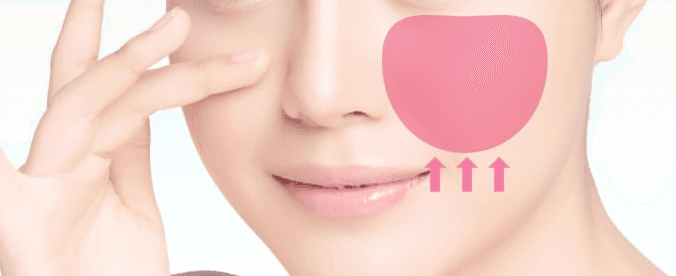 Midface lift treatment area