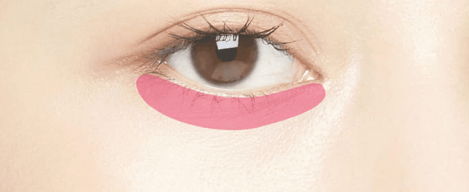 Tear trough augmentation treatment area