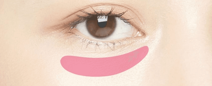 Under-eye fat removal treatment area