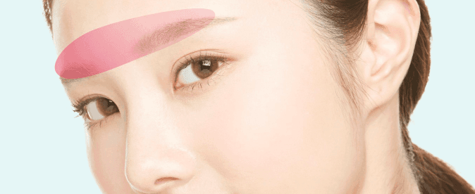 Brow bone contouring treatment area