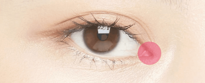 Inner corner incision treatment area