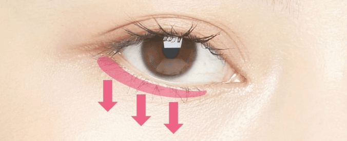 Lower eyelid enlargement treatment area