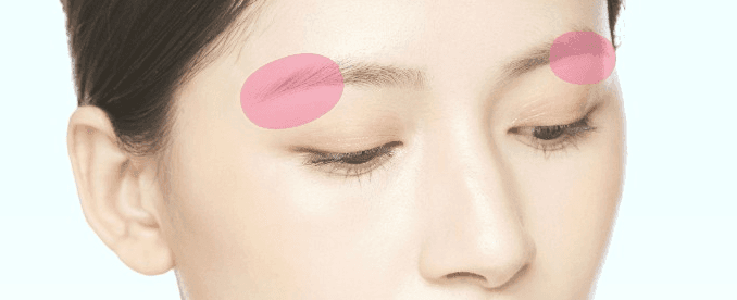 Orbital rim contouring treatment area