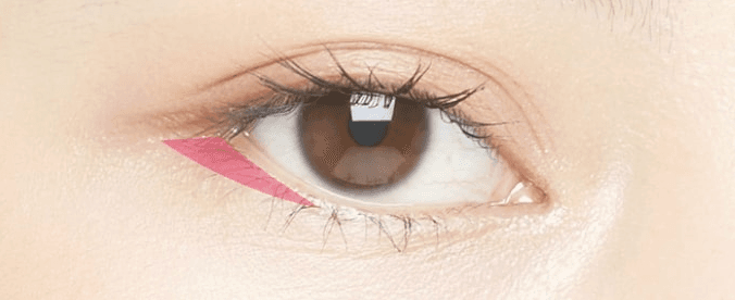 Outer corner incision treatment area