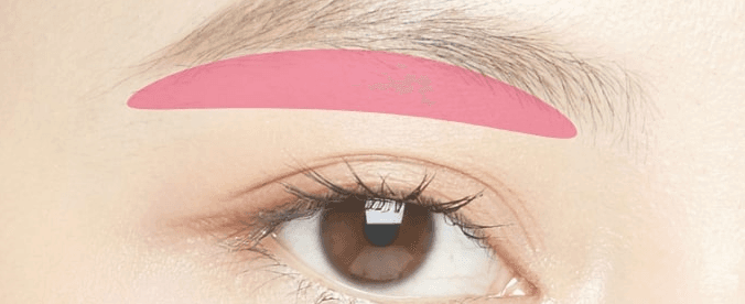 Sub-brow incision treatment area