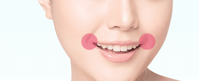 Corner lip lift treatment area