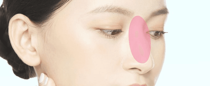 Nasal augmentation treatment area
