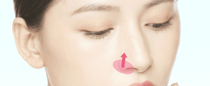 Nostril rim elevation treatment area
