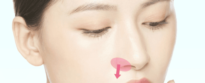 Nostril rim lowering treatment area