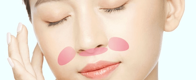 Paranasal and nasolabial angle surgery treatment area