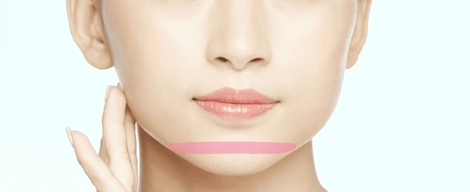 Treatment area for chin shortening