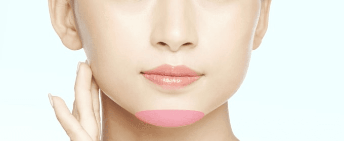 Treatment area for genioplasty
