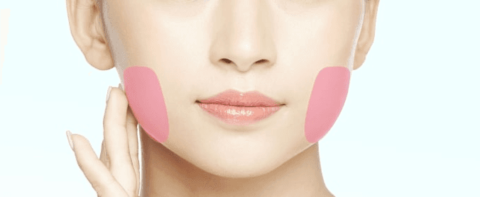 Treatment area for mandibular angle reduction