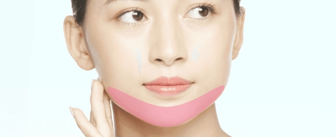 Treatment areas for V-line surgery