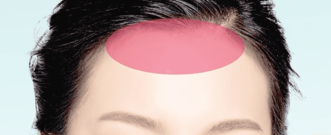 Forehead lift treatment area