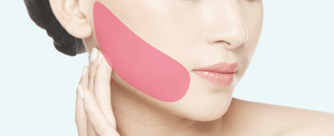 Facelift treatment area