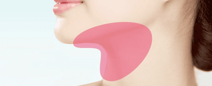 Platysmaplasty treatment area
