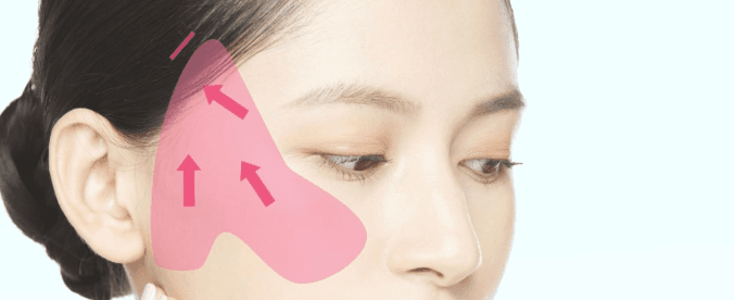 Ponytail lift treatment area