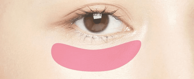 Under-eye sagging correction treatment area