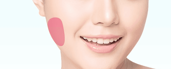 Botox injections for facial contouring