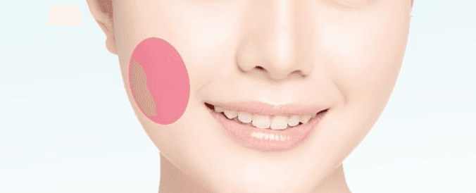 Buccal fat removal treatment area