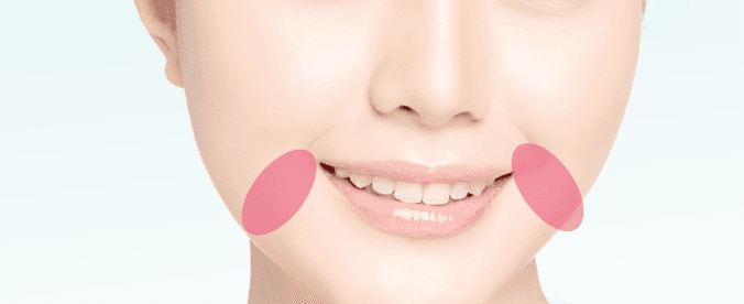 Jowl fat removal treatment area