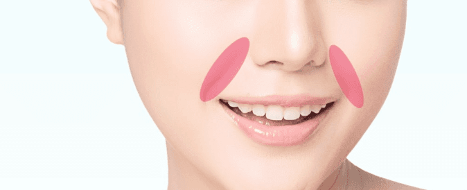 Nasolabial fat removal treatment area
